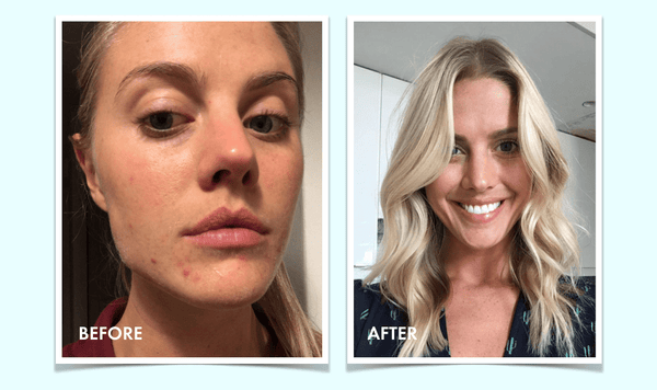 The answer to acne: An interview with a Vitaclean convert